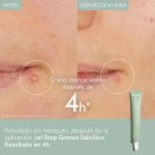 2 Vinopure Stop Boutons Before After Caudalie ES